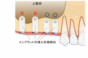 http://www.implant-map.jp/imp8/s-03.jpg